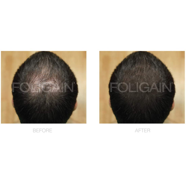 FOLIGAIN Minoxidil 5% Hair Regrowth Treatment For Men - FOLIGAIN EU